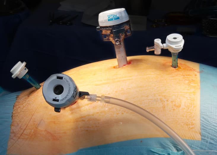 Small laparoscopic incision sites after minimally invasive surgery.